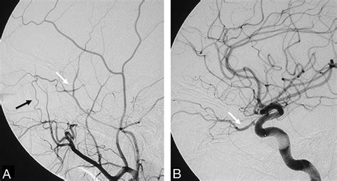 External Carotid Artery Branches Angiogram