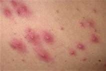 MRSA & Treatment - Skin Infections – (CA MRSA)