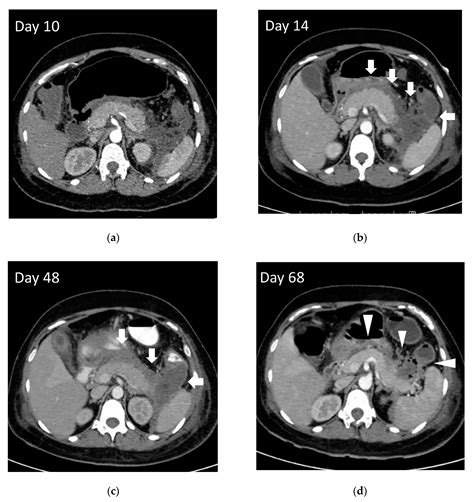 JCM Free Full Text When Should We Perform Endoscopic Drainage And