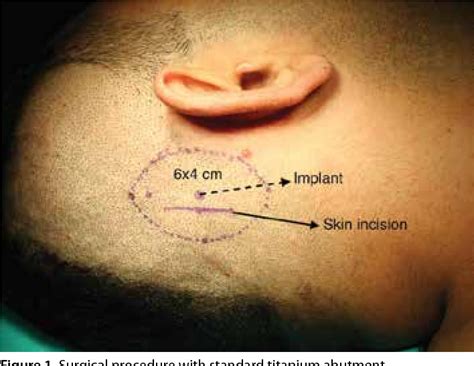 Figure 1 From Two Different Percutaneous Bone Anchored Hearing Aid