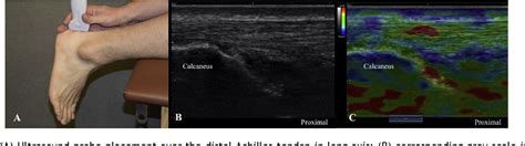 Figure From Ultrasound Elastography And Ultrasound Tissue