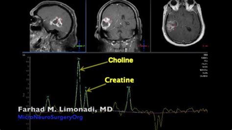 Brain Tumor Surgical Removal Of Glioblastoma Using Fluorescein Sodium