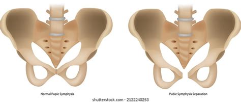 Pubic Symphysis Separation Spd Symphysis Pubis Stock Vector Royalty Free 2122240253 Shutterstock