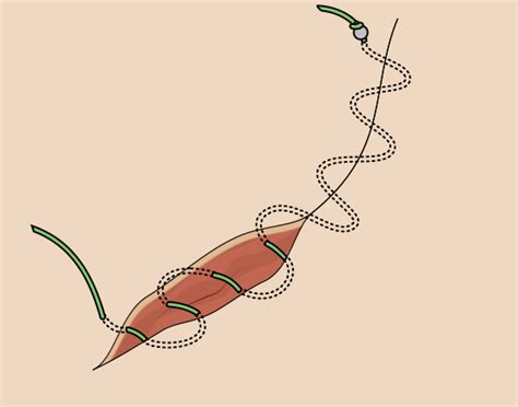 suturing techniques surgsoc