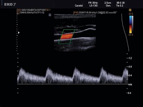 Ultrasound images • Internal carotid artery, CFM & PW, echogramm №492