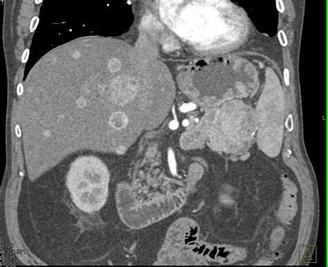 Pancreatic Neuroendocrine Tumor Pnet Tail Of The Pancreas With Liver