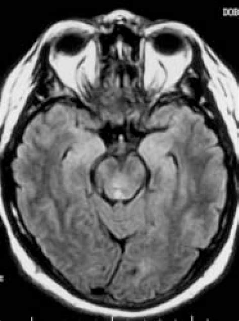 Axial Flair Mri Through The Caudal Midbrain In A Patient With A Right