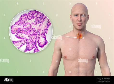 Thyroid Cancer Illustration Stock Photo Alamy