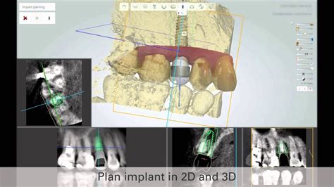 3shapes New Implant Studio™ Youtube