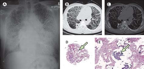 Pulmonary Alveolar Microlithiasis—a Rare Lung Disease—diagnosed By Transbronchial Cryobiopsy