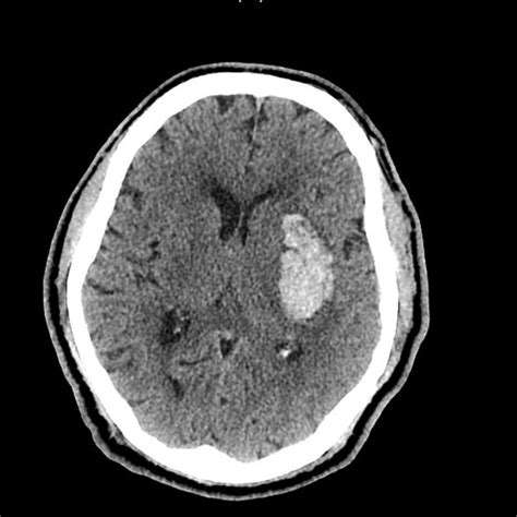 Ct Head Without Contrast Showing Acute Left Basal Ganglia Hematoma