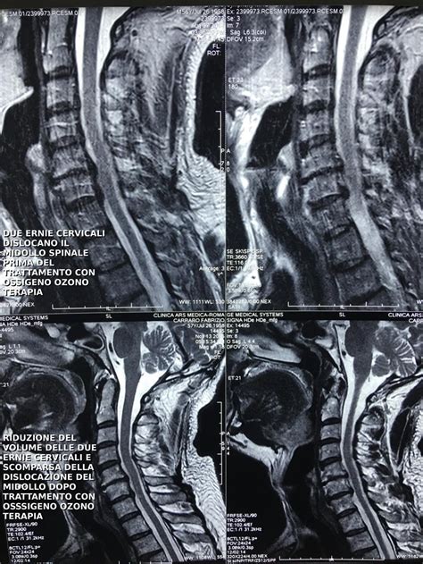 Ozonoterapia Nel Trattamento Dell Ernia Del Disco Cervicale E Lombare