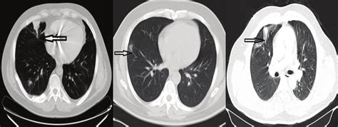 Feeding Vessel Sign Black Arrow Observed On Thoracic Computed Download Scientific Diagram