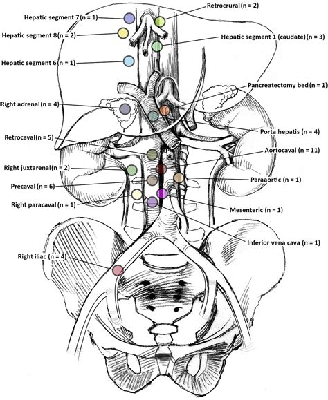 Intravascular Ultrasound Guided Transvenous Biopsy Of Abdominal And