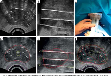 Figure 1 From Single Fraction High Dose Rate Brachytherapy Using Real