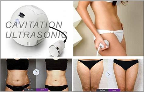 Does Ultrasonic Cavitation Really Reduce Cellulite