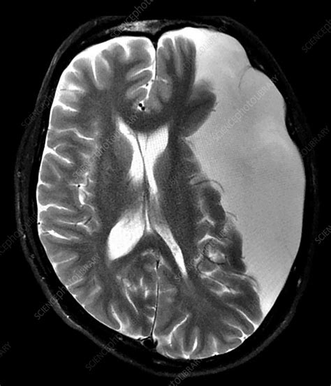 Large Arachnoid Cyst Mri Stock Image C0393914 Science Photo Library