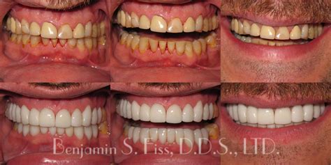 Porcelain Crowns And Bridges In Chicago Il Chicago Benjamin S Fiss D D S