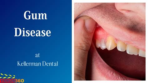 Gum Disease Treatment At Kellerman Dental Youtube