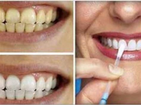 Topo Imagem Clarear Dentes Violeta Genciana Br Thptnganamst