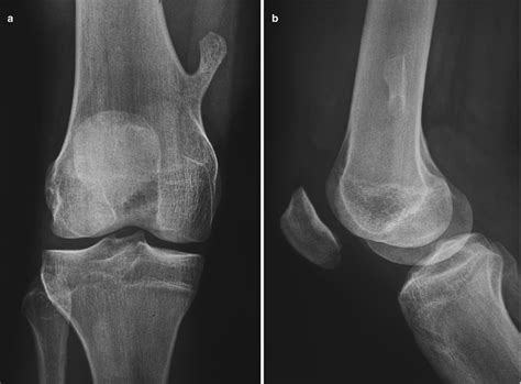 Osteochondroma Distal Femur