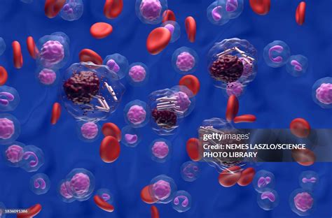 Auer Rods In Acute Promyelocytic Leukaemia Illustration High-Res Vector Graphic - Getty Images