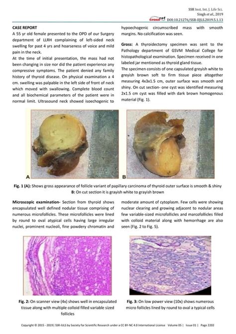 Encapsulated Follicular Variant Papillary Carcinoma Thyroid Pdf