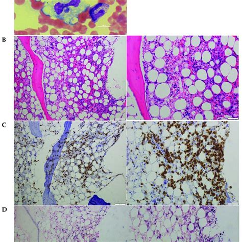 Hemophagocytosis Was Found In Bone Marrow Biopsy Smear May Giemsa