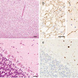 Histopathology HE And PrP Sc Immunostaining Of Monkey Brain