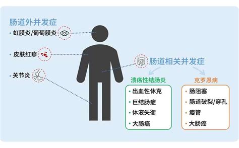 溃疡性结肠炎和肠易激综合征的区别