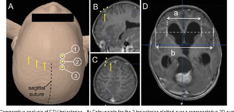 Figure 1 From Comparative Analysis Of Endoscopic Third Ventriculostomy Trajectories In Pediatric