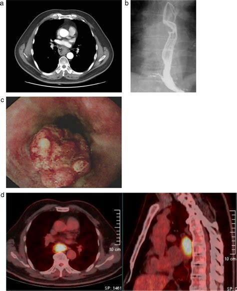 A Contrastenhanced Chest Computed Tomography Demonstrates Thickening