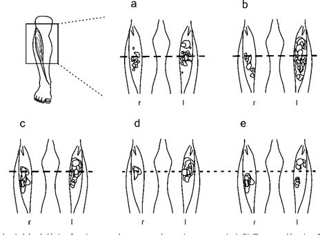 Figure 2 From Mapping The Motor Point In The Human Tibialis Anterior