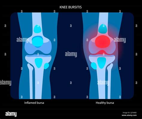 Bursitis rotuliana Fotos e Imágenes de stock Alamy