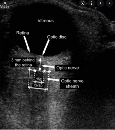 Ultrasound of Optic Nerve Sheath Diameter and Stroke Outcomes – St ...