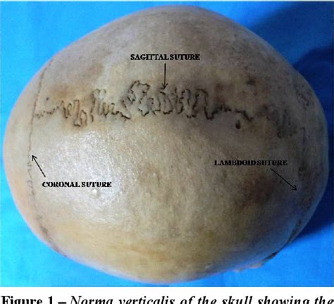 Figure 1 From Morphological Investigation Of Cranial Sutures In Indian