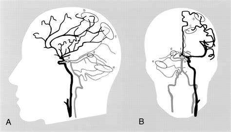 Collateral Circulation Stroke