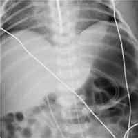 Pulmonary Aeration And Posterior Collapse Assessed By Electrical