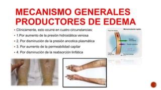 Edema Diapositivas Pptx