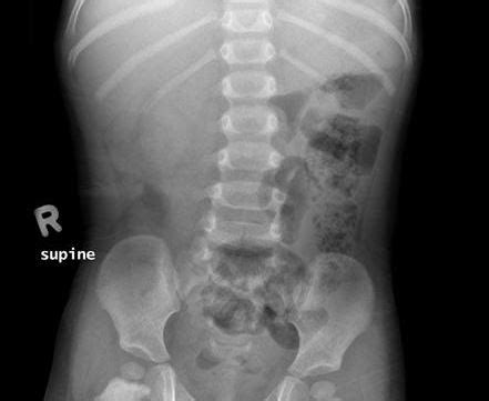 Intussusception - Symptoms, What is, Treatment, Pictures