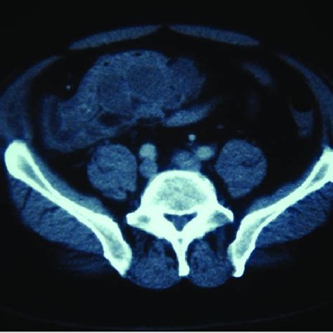 Computed Tomographic Findings Of A Plastron Or Perforated Appendicitis