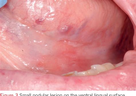 Pdf The Early Diagnosis Of Small Sized Oral Squamous Cell Carcinoma