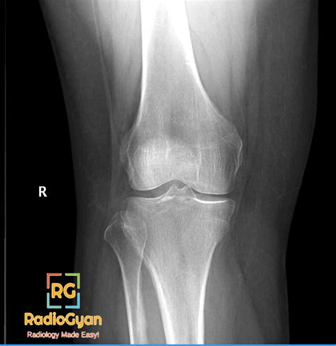 Tibial Condyle Fracture