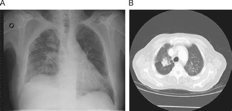 Unusual Exposure Source In A Patient With Silicosis Archivos De