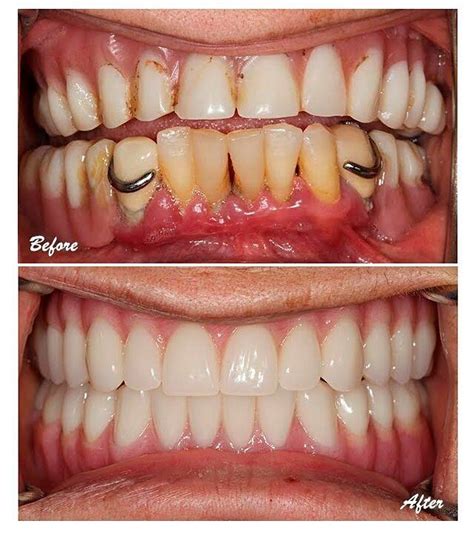 Severe Gingivitis Before And After