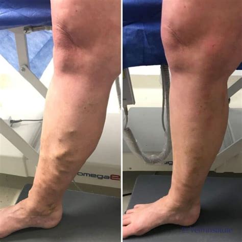 Endovenous Laser Ablation Treatment Varicose Vein Removal