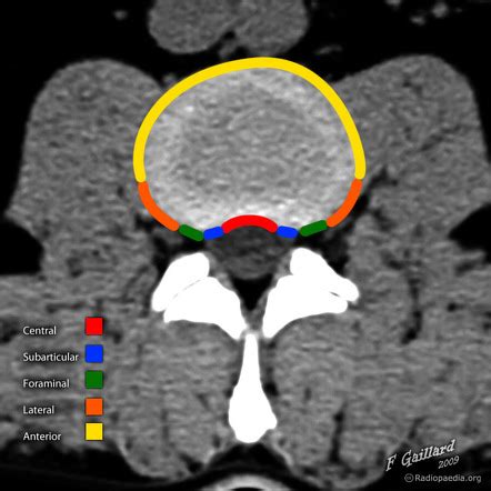 Radiology Quiz 40590 Radiopaedia Org Playlist Degenerative Spine