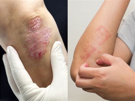 Malattie Della Pelle Simili Alla Psoriasi Derma Point