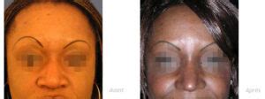 RHINOPLASTIE ETHNIQUE PEAU NOIRE Dr Ouakil