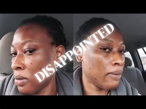 Chemical Peel Experience No Peel Full Process Before After Youtube